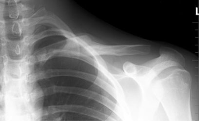 Figure 2b: Healed fracture 5 months following injury, returned to football.
